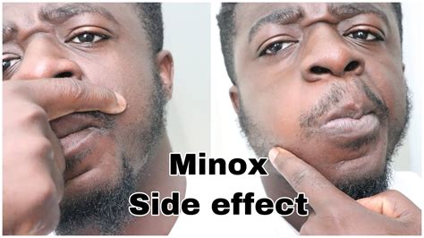 rogin-e side effects